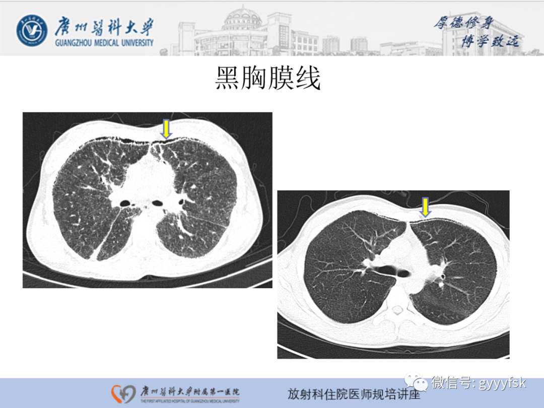 【PPT】肺泡微石症阅片指导-18