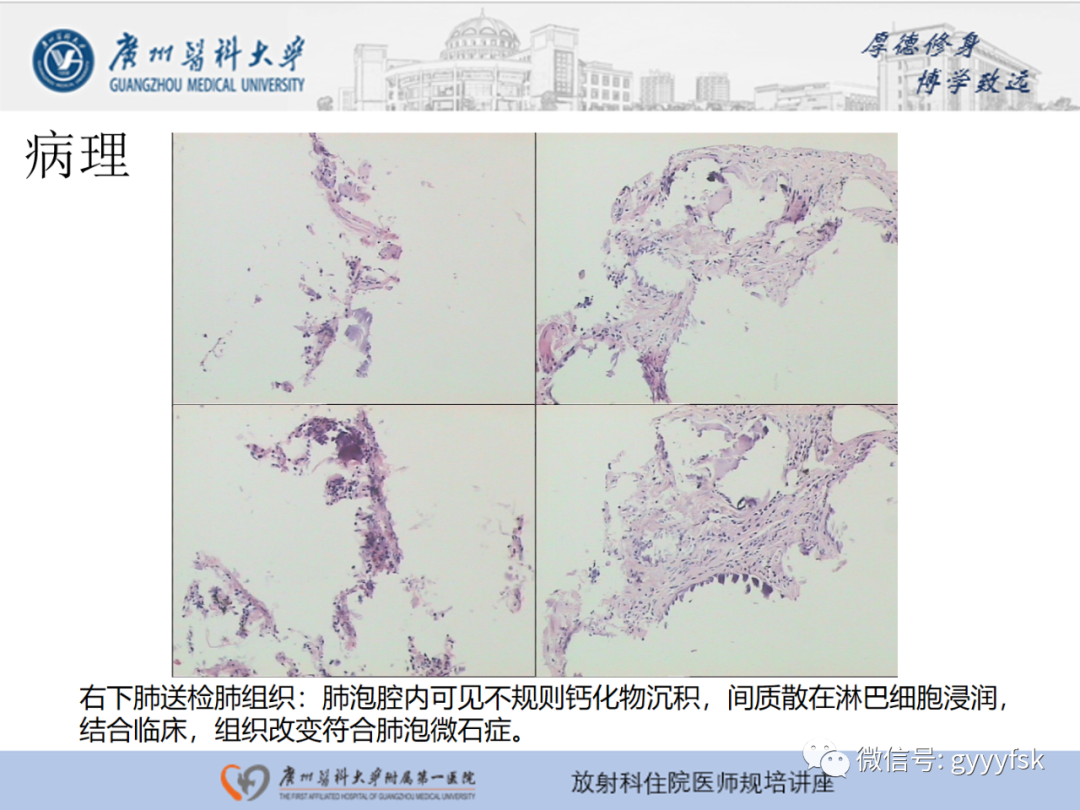 【PPT】肺泡微石症阅片指导-7