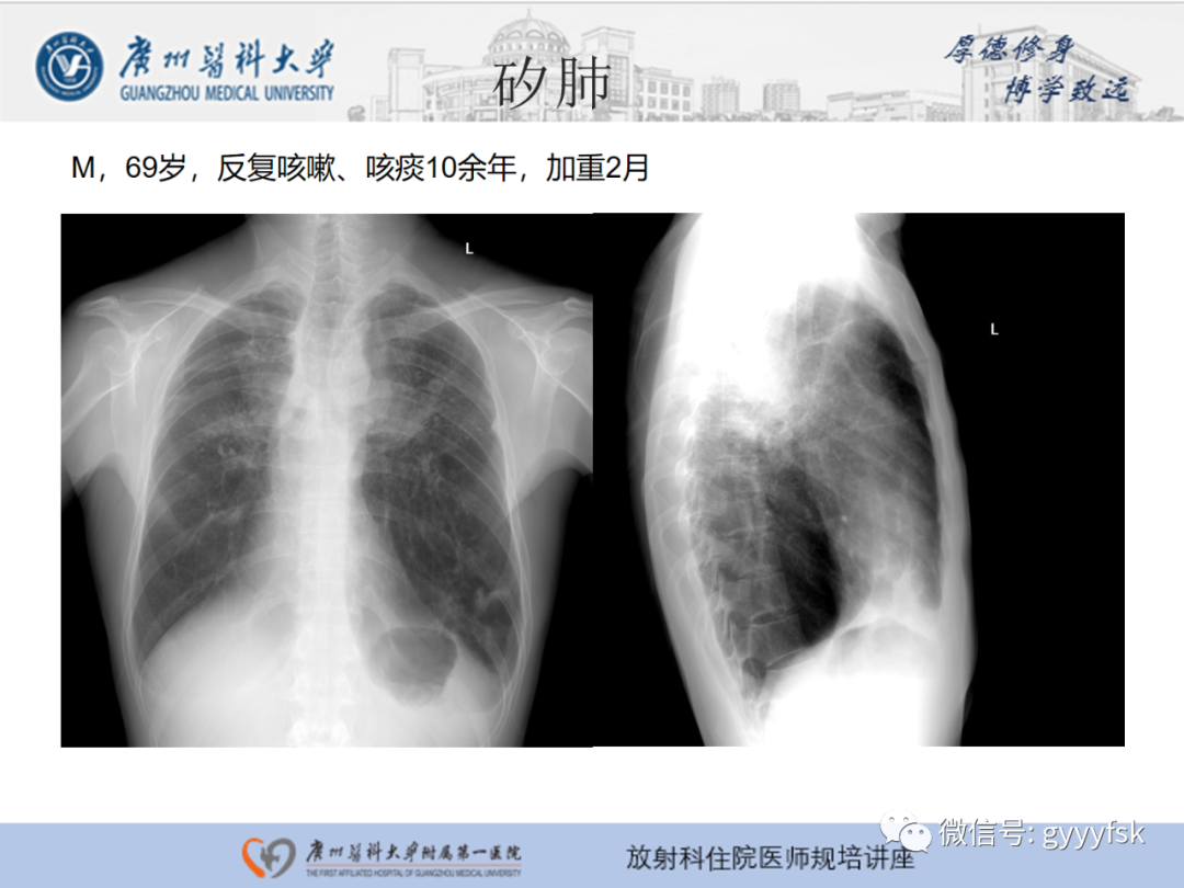 【PPT】肺泡微石症阅片指导-27