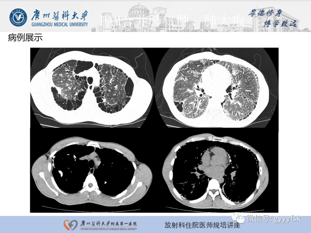 【PPT】肺泡微石症阅片指导-22