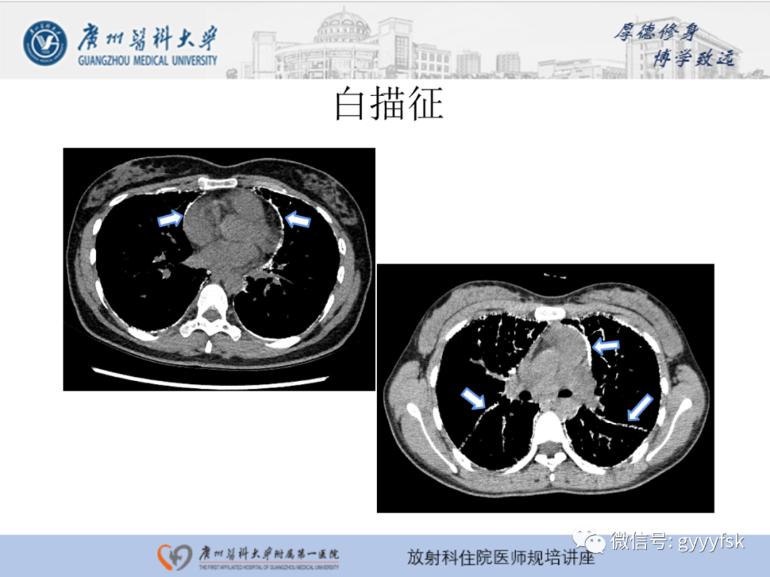 【PPT】肺泡微石症阅片指导-16