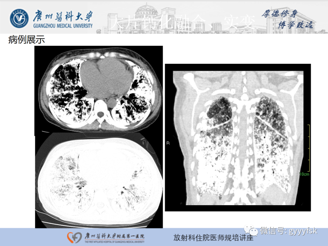 【PPT】肺泡微石症阅片指导-21