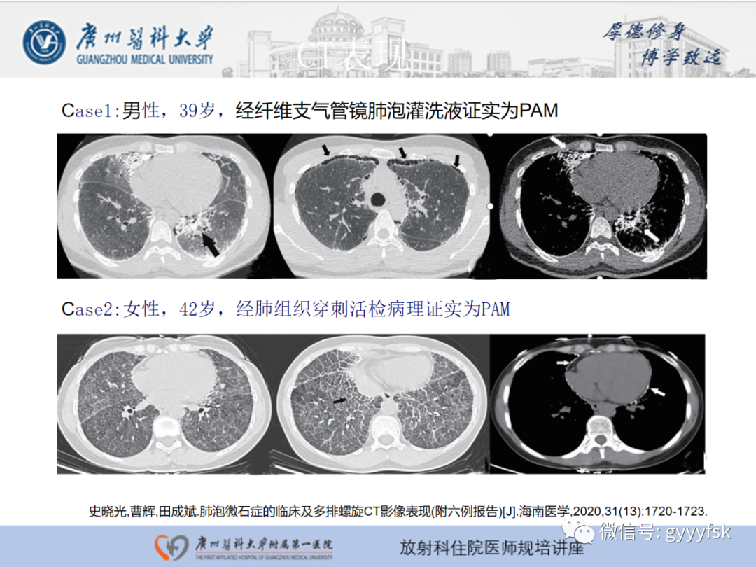 【PPT】肺泡微石症阅片指导-15