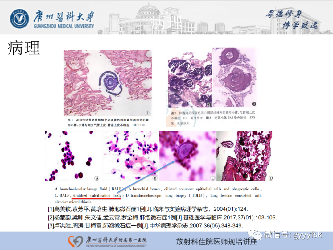 【PPT】肺泡微石症阅片指导-8