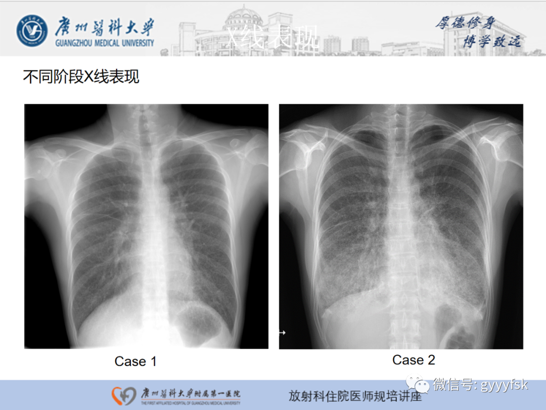 【PPT】肺泡微石症阅片指导-12
