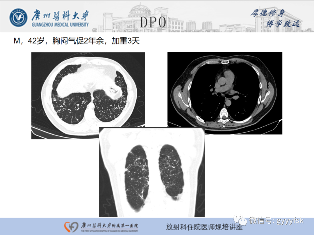 【PPT】肺泡微石症阅片指导-29