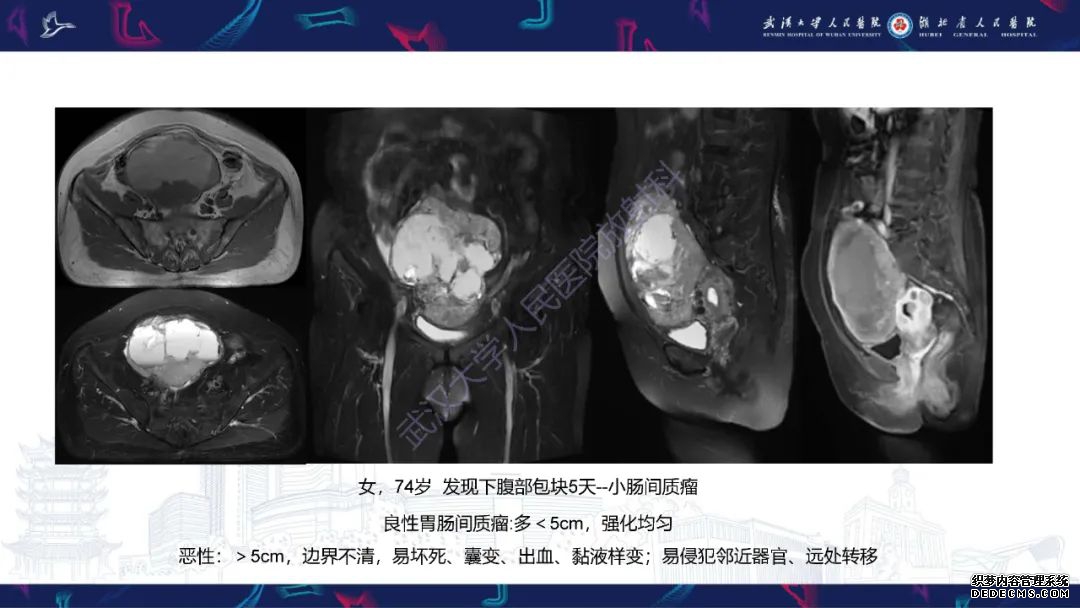 【PPT】盆腹腔巨大占位性病变影像诊断-71