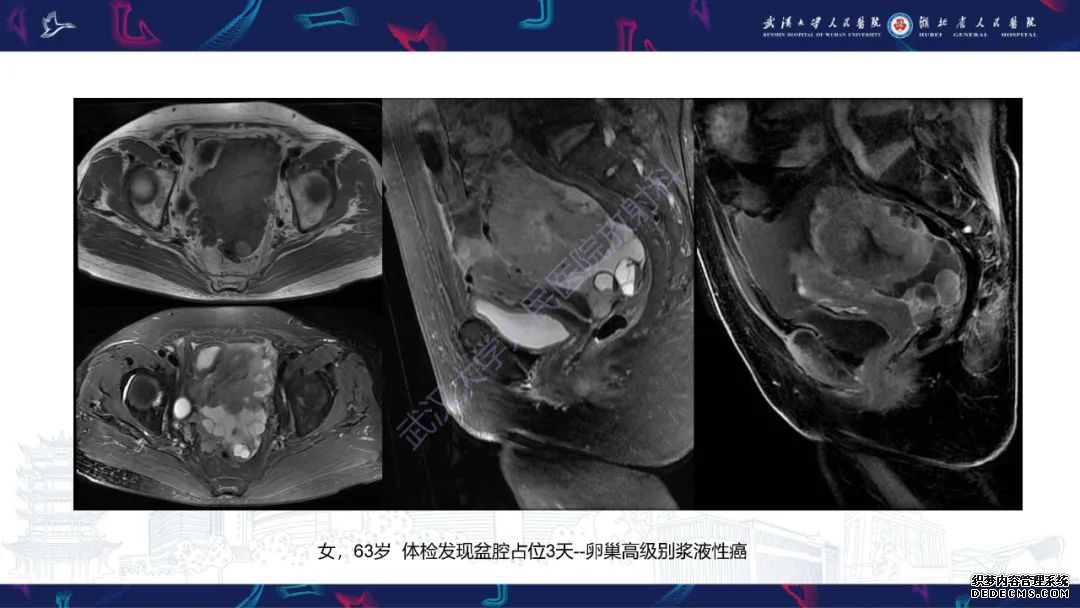 【PPT】盆腹腔巨大占位性病变影像诊断-75