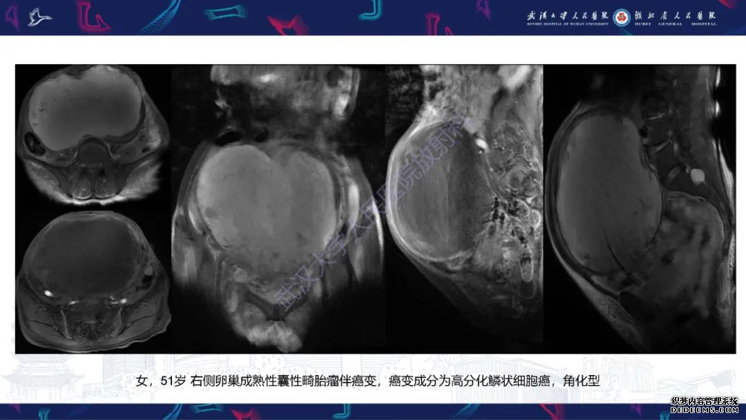【PPT】盆腹腔巨大占位性病变影像诊断-67