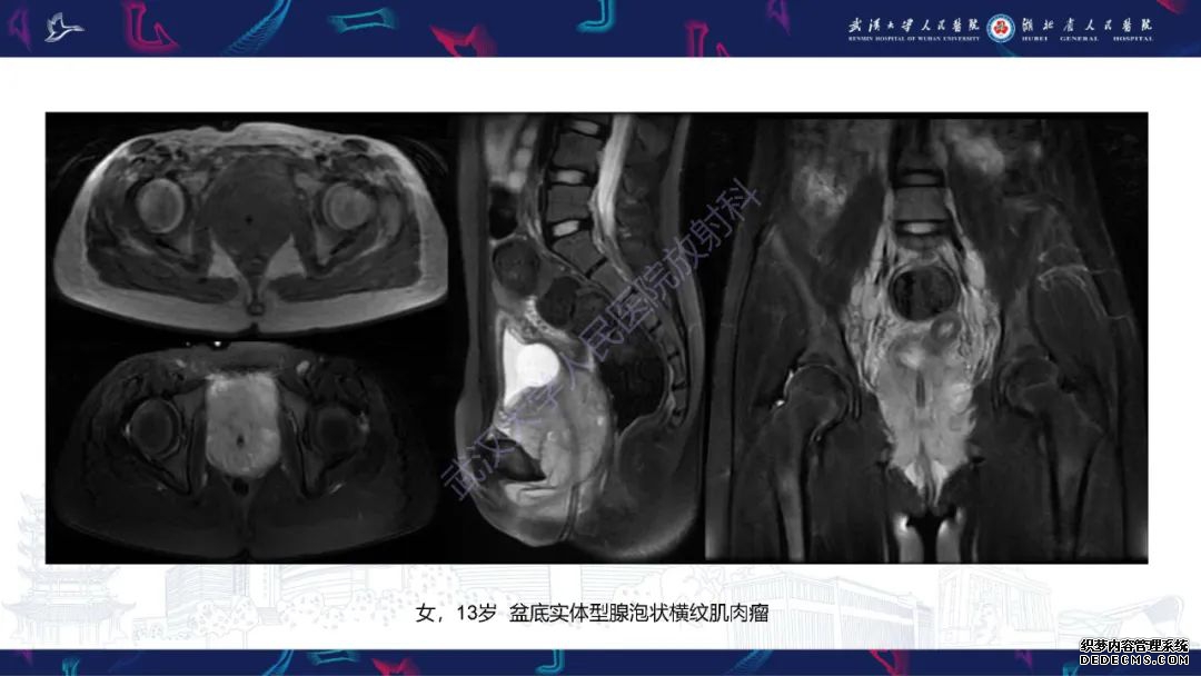 【PPT】盆腹腔巨大占位性病变影像诊断-82