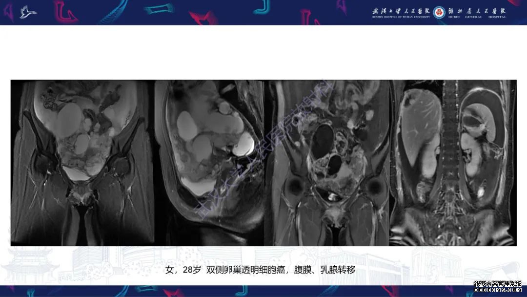 【PPT】盆腹腔巨大占位性病变影像诊断-63