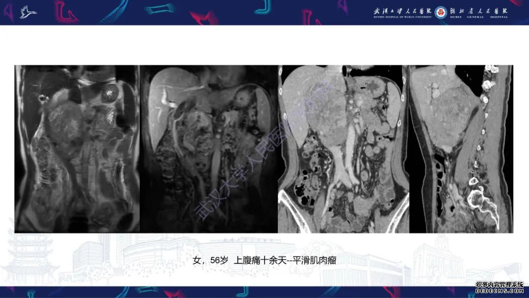 【PPT】盆腹腔巨大占位性病变影像诊断-43