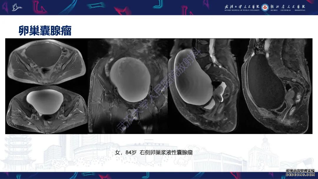 【PPT】盆腹腔巨大占位性病变影像诊断-15