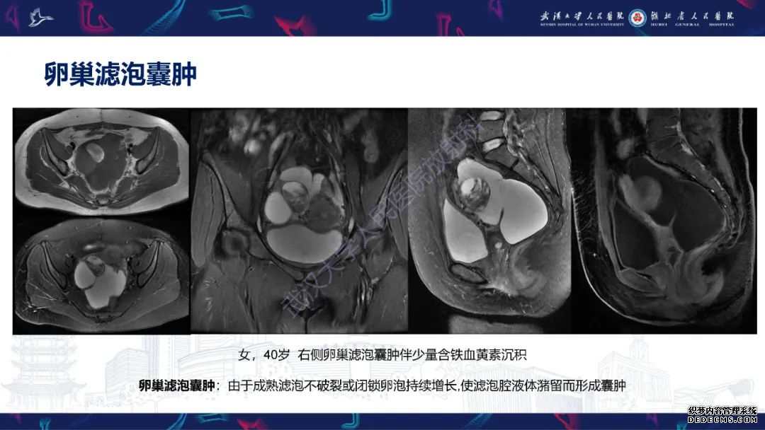 【PPT】盆腹腔巨大占位性病变影像诊断-13