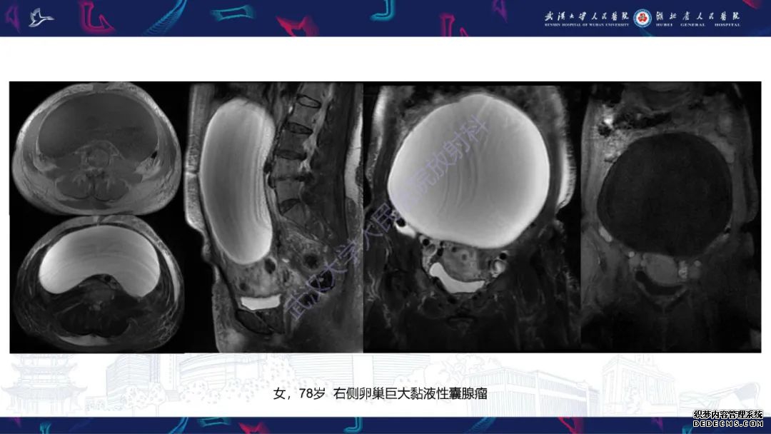 【PPT】盆腹腔巨大占位性病变影像诊断-20