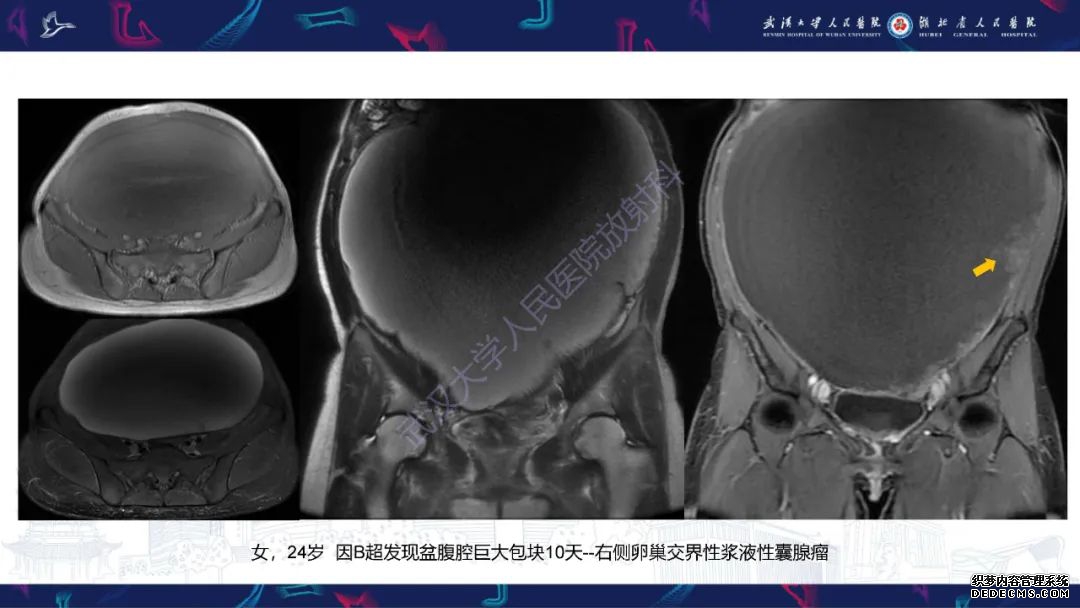 【PPT】盆腹腔巨大占位性病变影像诊断-24