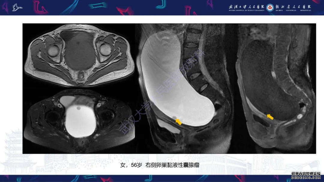 【PPT】盆腹腔巨大占位性病变影像诊断-21