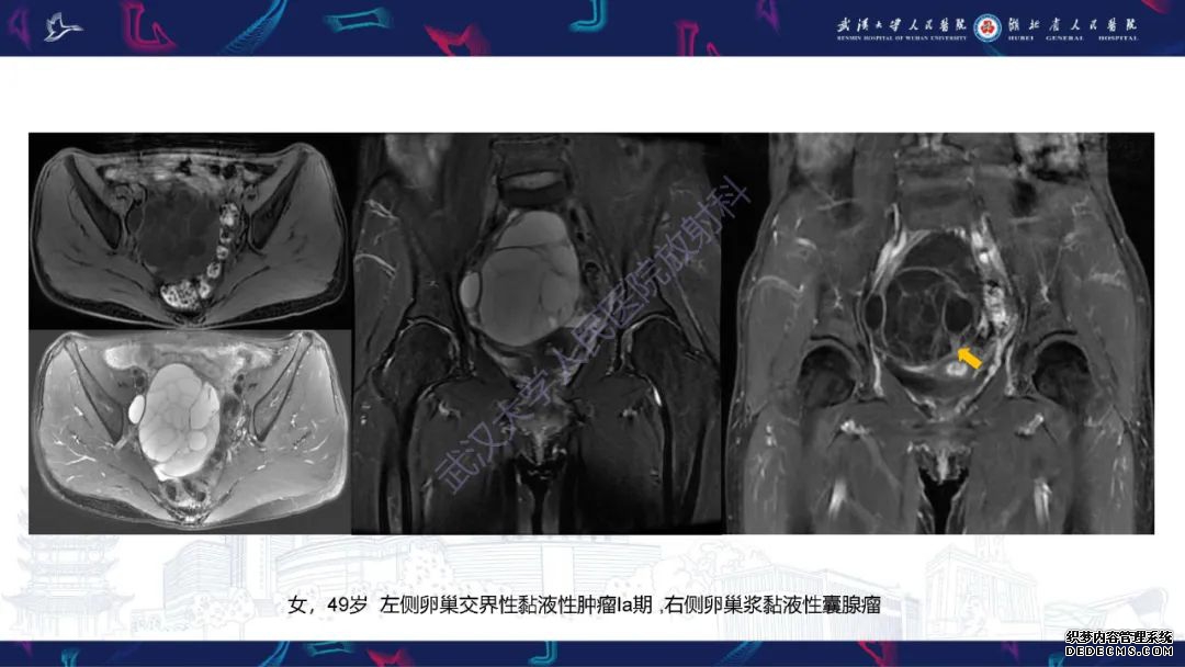 【PPT】盆腹腔巨大占位性病变影像诊断-32