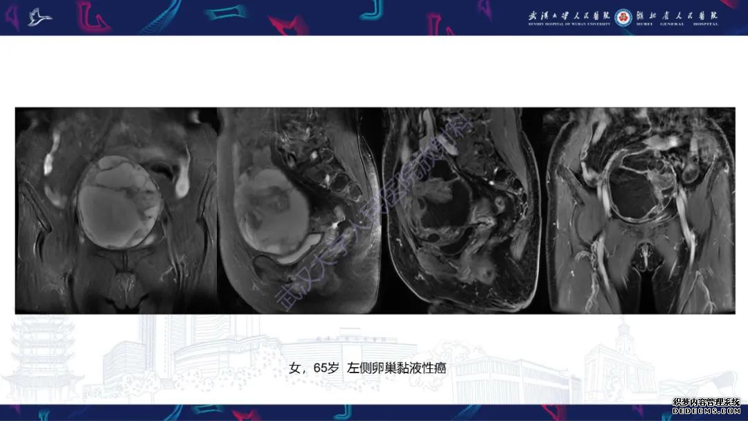 【PPT】盆腹腔巨大占位性病变影像诊断-77