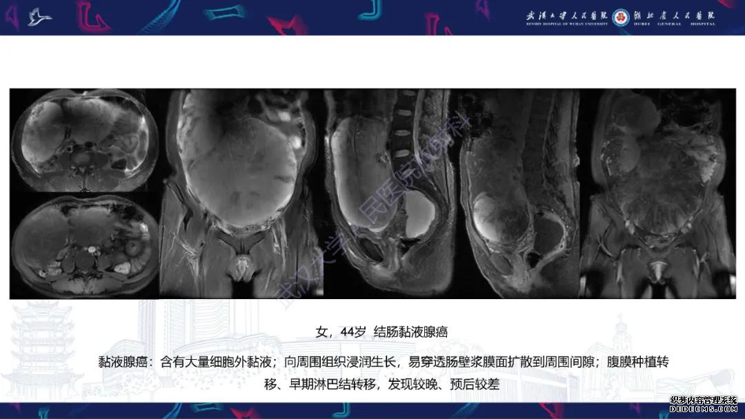 【PPT】盆腹腔巨大占位性病变影像诊断-68