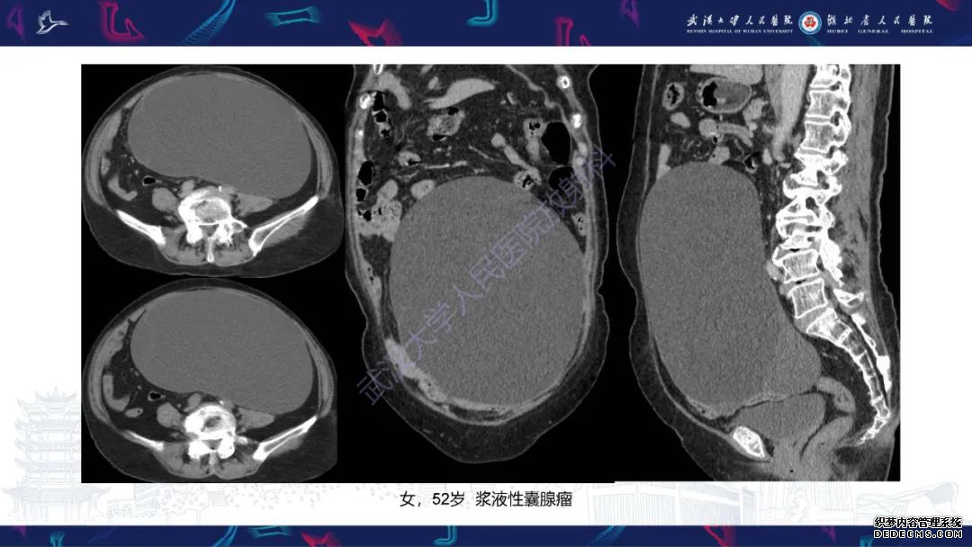 【PPT】盆腹腔巨大占位性病变影像诊断-16