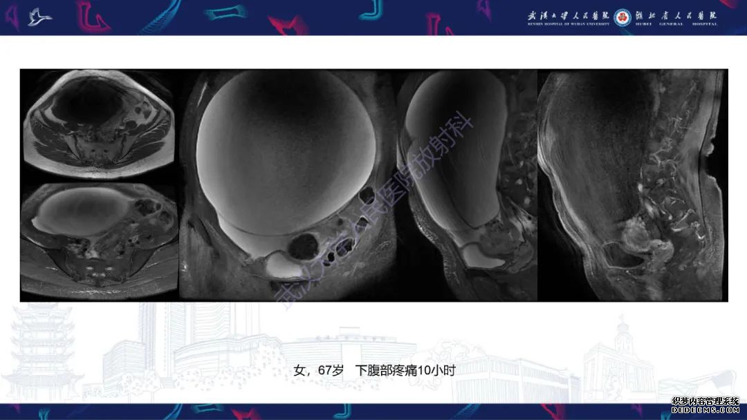 【PPT】盆腹腔巨大占位性病变影像诊断-3