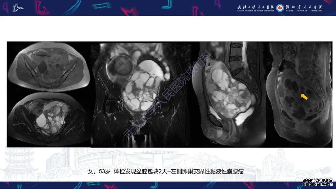 【PPT】盆腹腔巨大占位性病变影像诊断-31