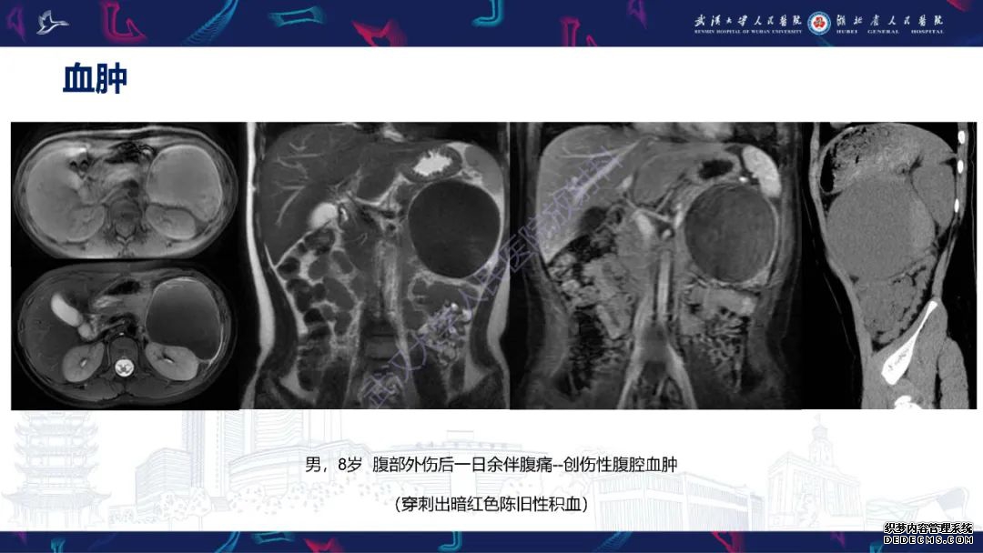 【PPT】盆腹腔巨大占位性病变影像诊断-10