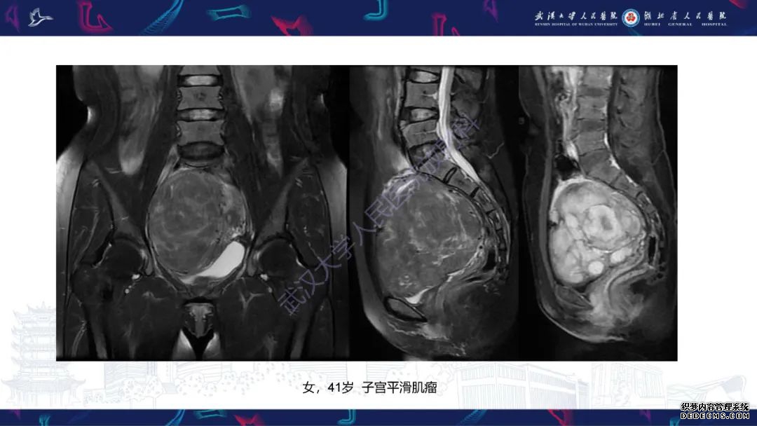 【PPT】盆腹腔巨大占位性病变影像诊断-54
