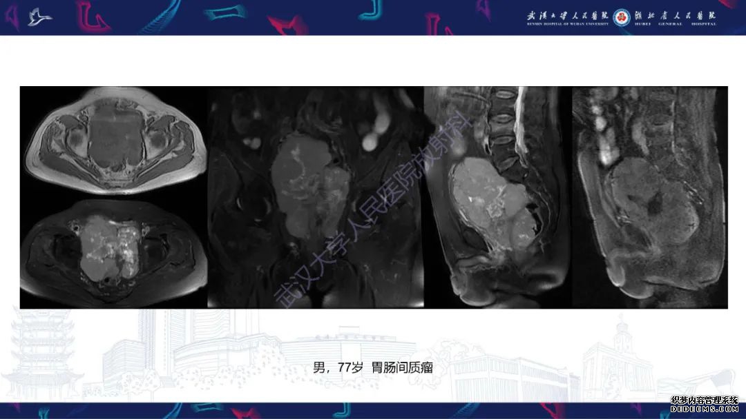 【PPT】盆腹腔巨大占位性病变影像诊断-81