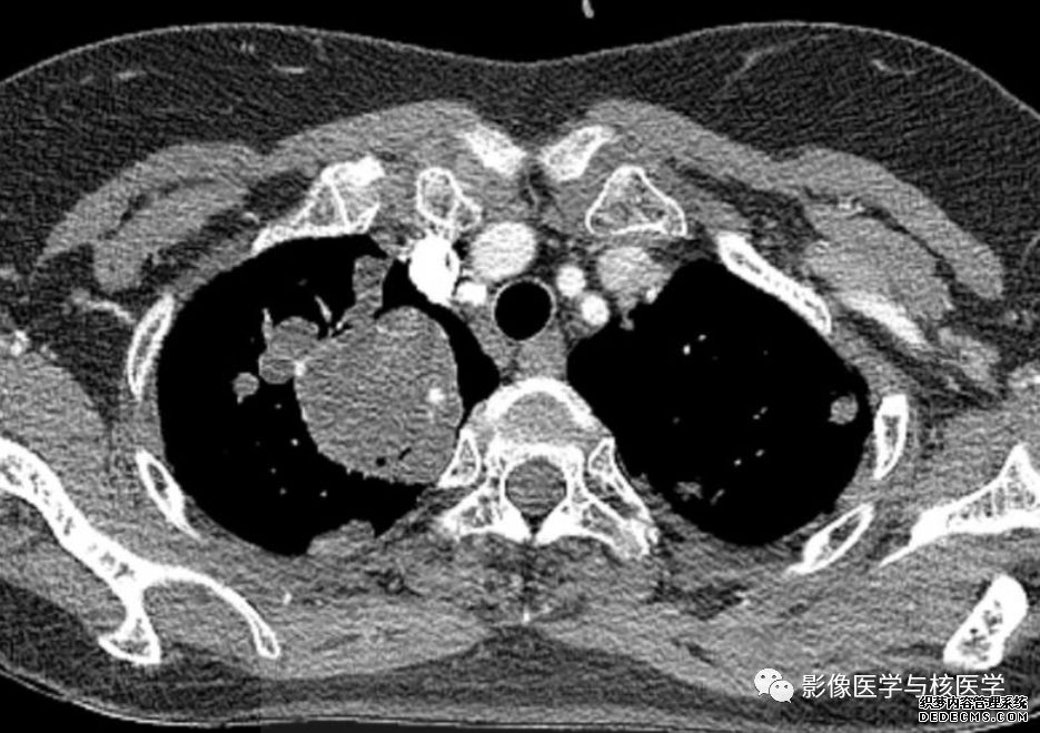 【病例】肺良性转移性平滑肌瘤病1例CT影像-4