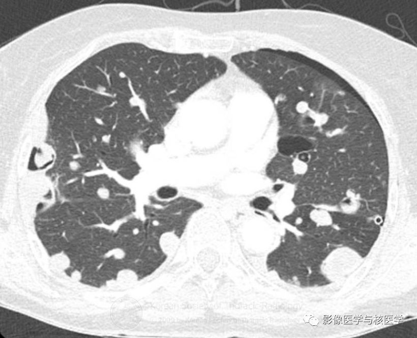 【病例】肺良性转移性平滑肌瘤病1例CT影像-3
