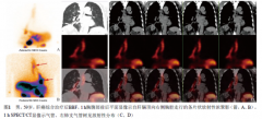 胆管支气管瘘SPECT/CT肝胆显像2例