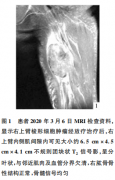 右上臂梭形细胞未分化肉瘤1例