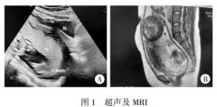 子宫前壁肌瘤导致妊娠子宫嵌顿１例病例报告