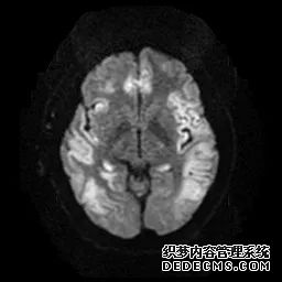 【病例】低血糖性脑病1例MR影像-20