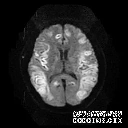 【病例】低血糖性脑病1例MR影像-21