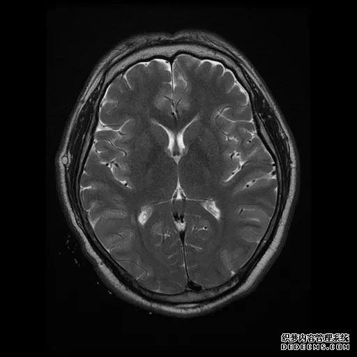 【病例】低血糖性脑病1例MR影像-17