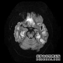 【病例】低血糖性脑病1例MR影像-19