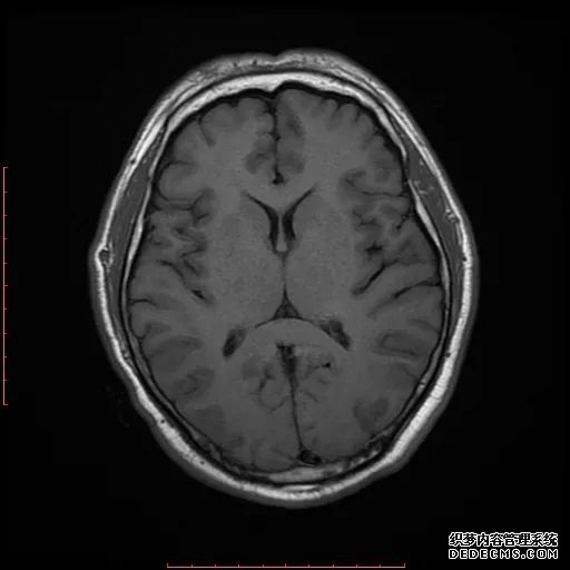 【病例】低血糖性脑病1例MR影像-16