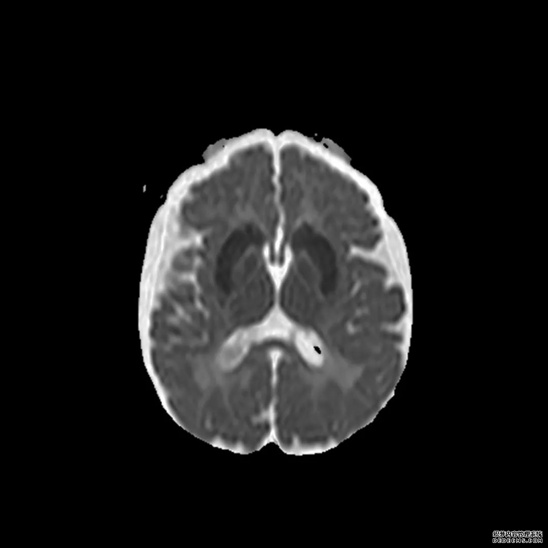 【病例】低血糖性脑病1例MR影像-14