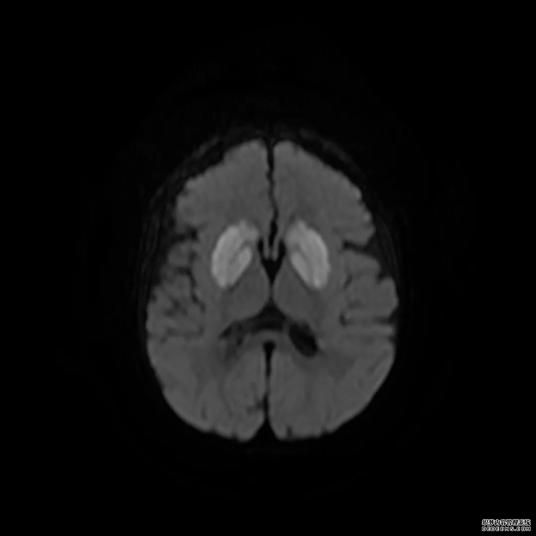 【病例】低血糖性脑病1例MR影像-13