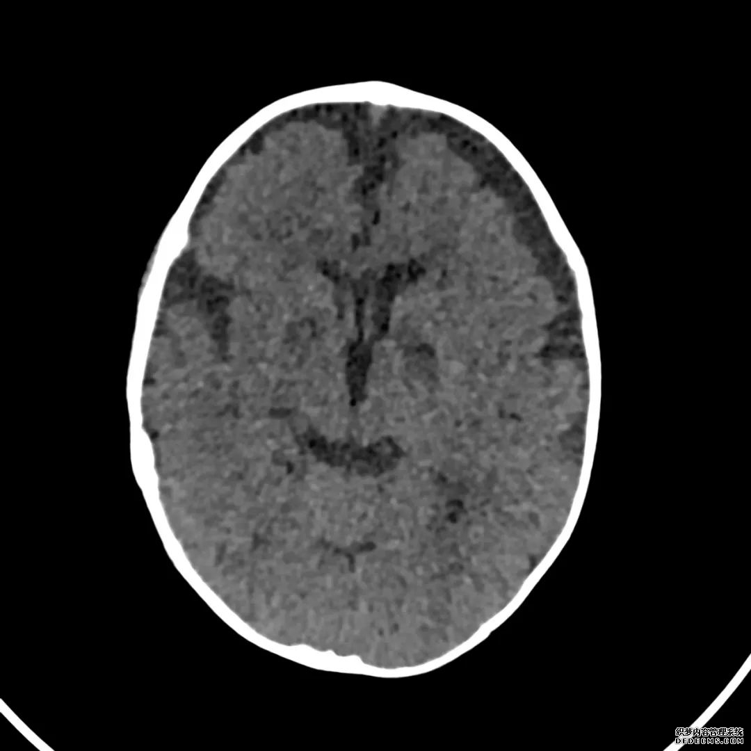 【病例】低血糖性脑病1例MR影像-3