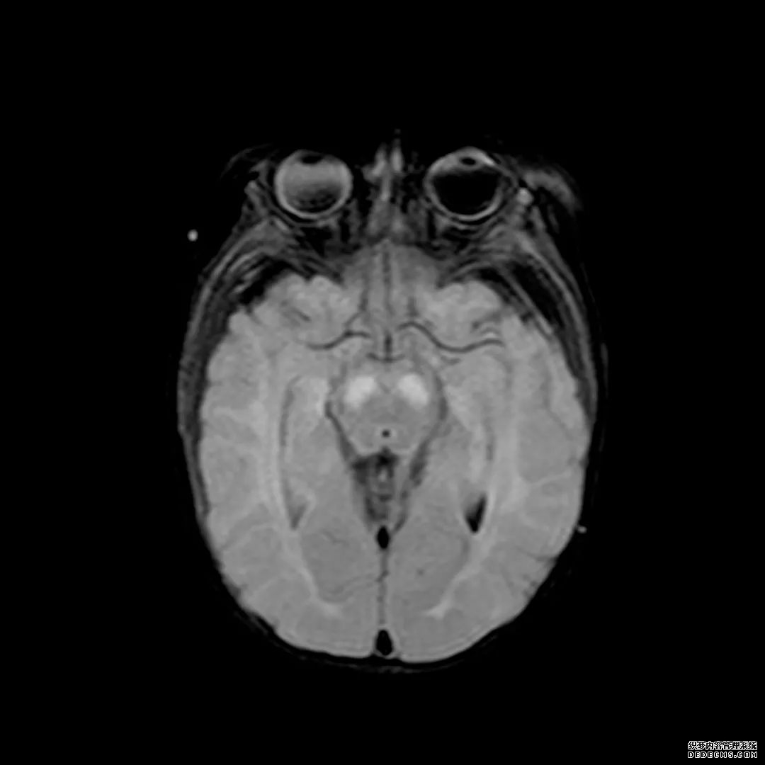 【病例】低血糖性脑病1例MR影像-10