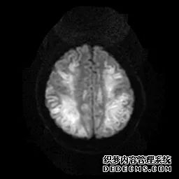 【病例】低血糖性脑病1例MR影像-23