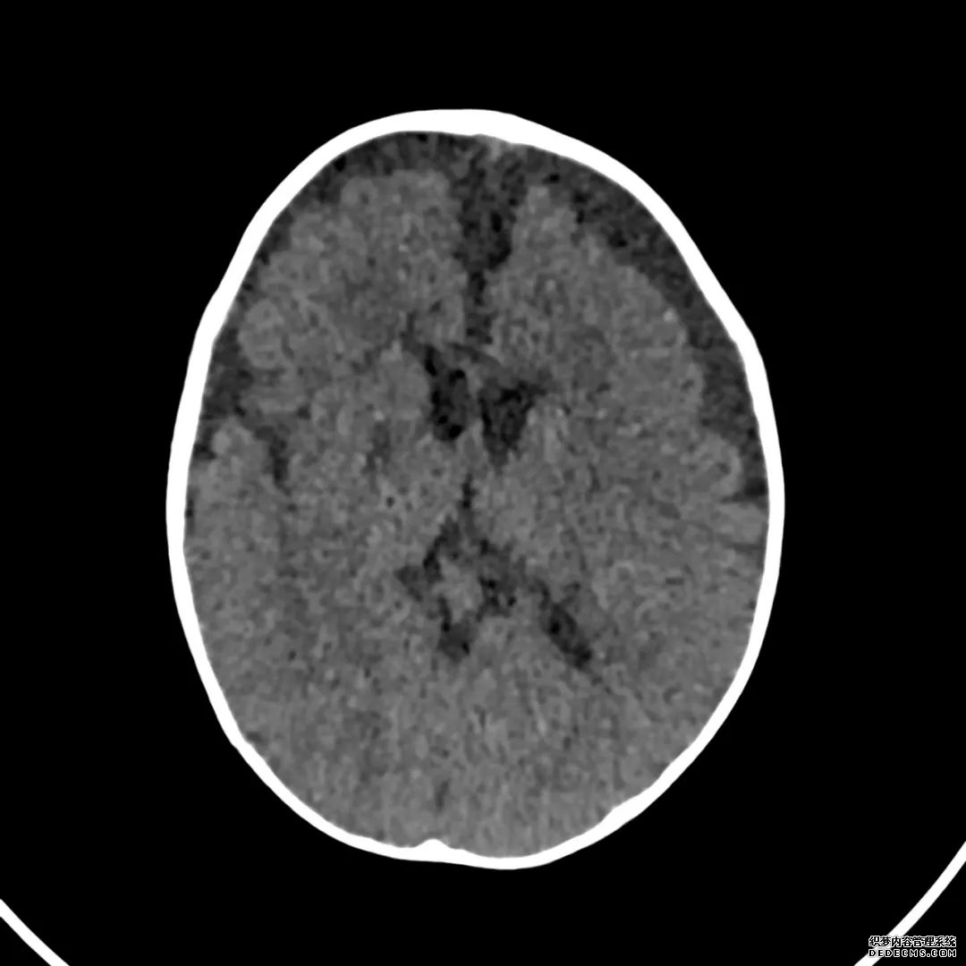 【病例】低血糖性脑病1例MR影像-6