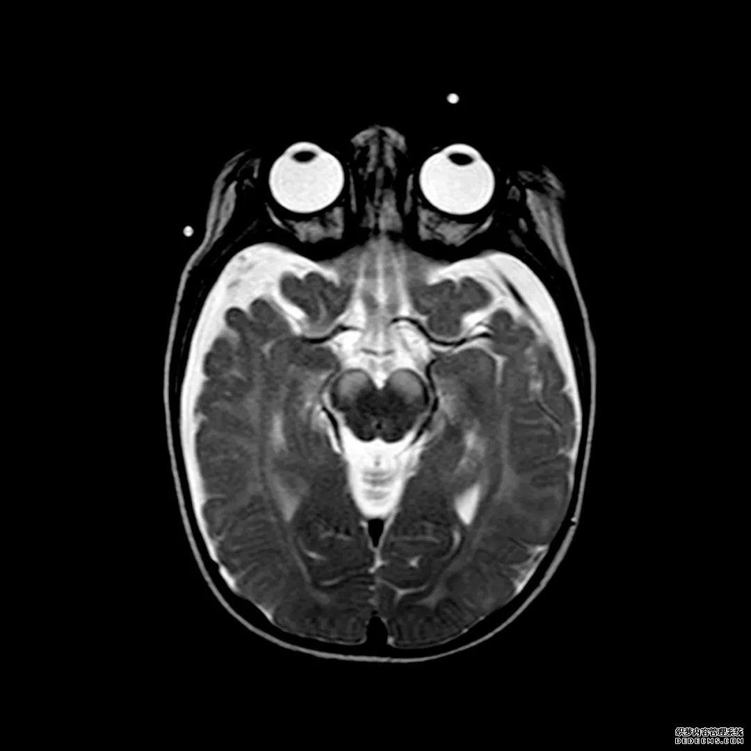【病例】低血糖性脑病1例MR影像-8