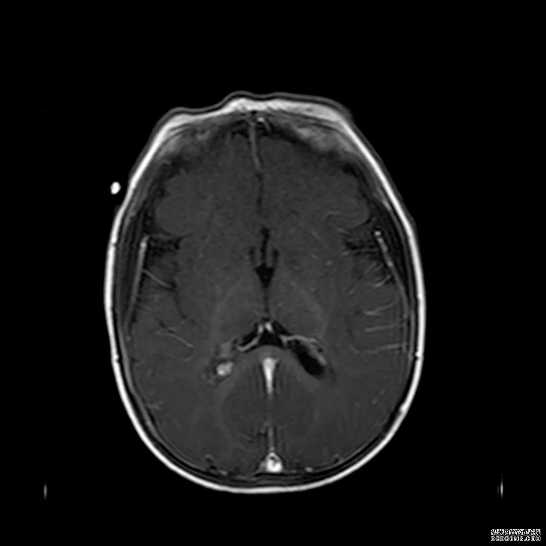 【病例】低血糖性脑病1例MR影像-15