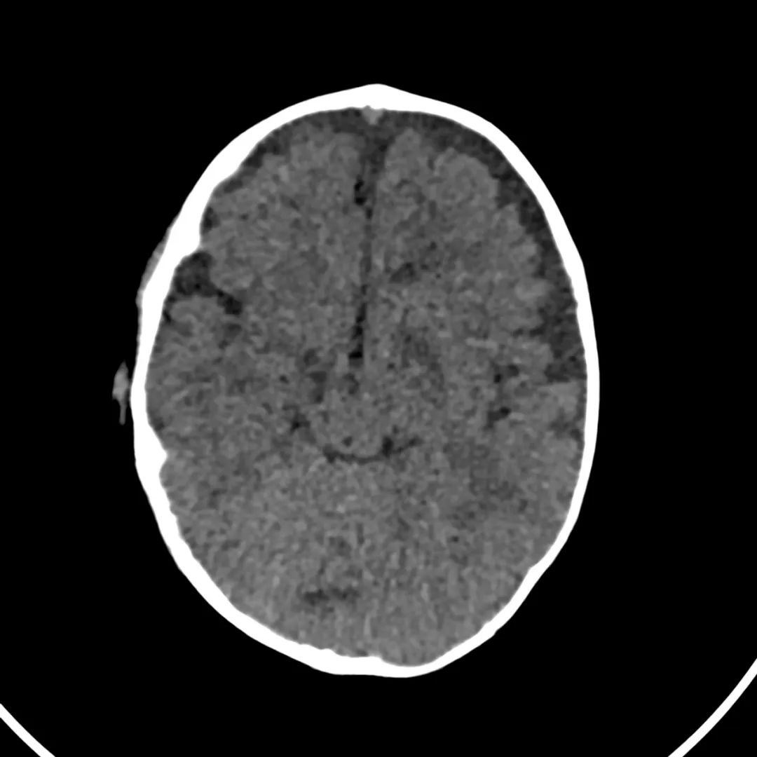 【病例】低血糖性脑病1例MR影像-1