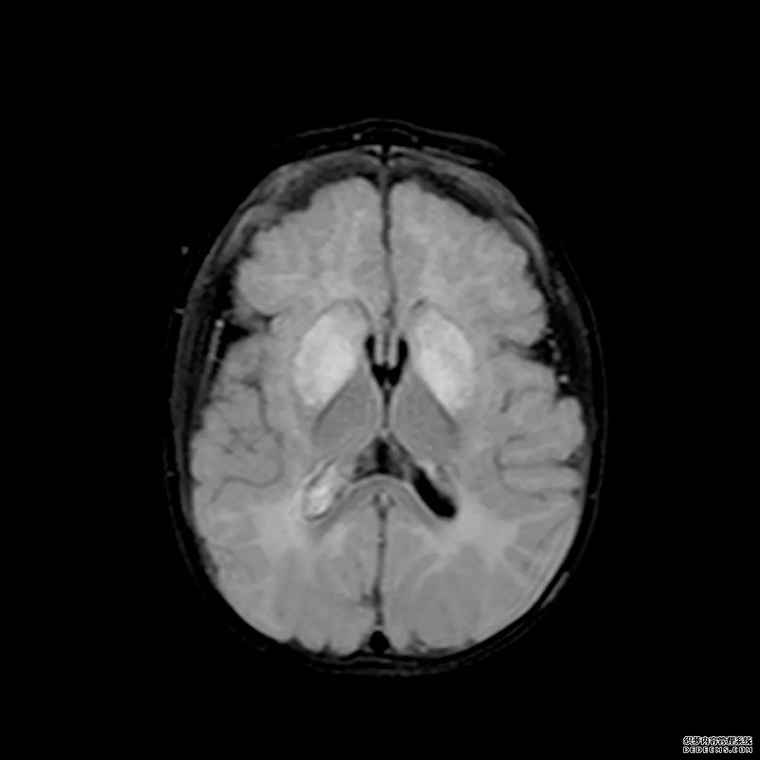【病例】低血糖性脑病1例MR影像-11
